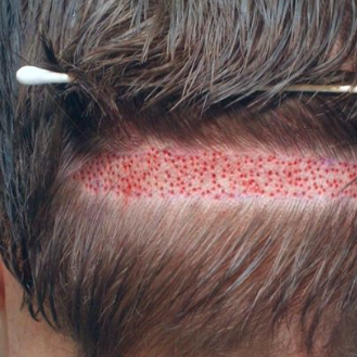 Hairtransplant